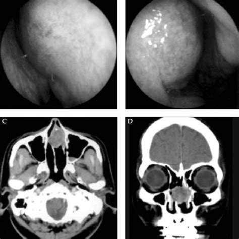 Pdf Nasal Septum Adenoid Cystic Carcinoma A Case Report