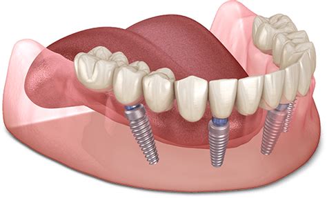 Full Mouth Dental Implants Ocala Fl Crystal River Fl