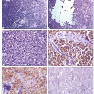 Merkel cell carcinoma (mcc) is an unusual primary neuroendocrine carcinoma of the skin. Electron micrograph of Merkel cell in the basal layer of oral... | Download Scientific Diagram