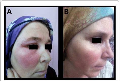 Cellulitis Face Treatment Doctor Heck