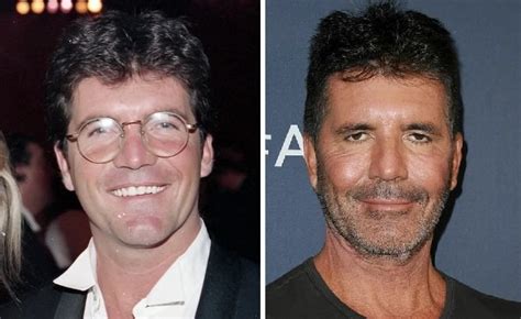 Simon Cowell Before And After Plastic Surgery Facelift Botox
