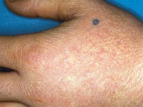 Rare Skin Diseases