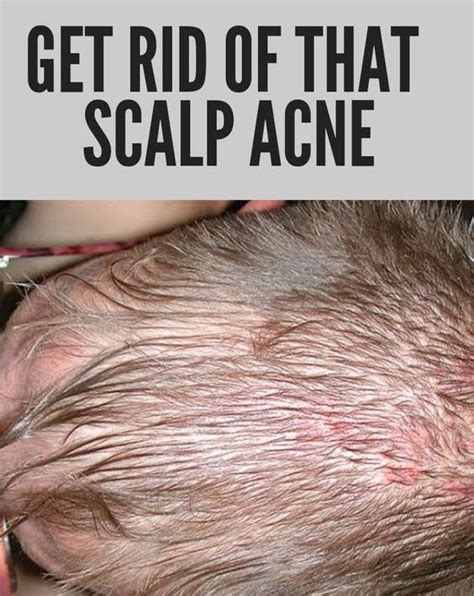 How To Get Rid Of Scalp Acne In 2020 Pimples On Scalp Scalp Acne