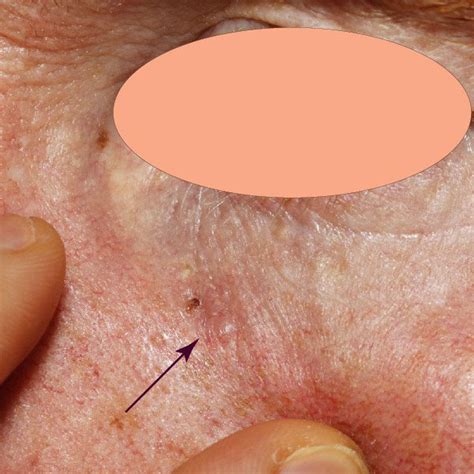 Basal Cell Carcinoma The Definitive Guide Skintel