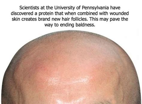 People Have Long Been Waiting For A Valid Breakthrough On Baldness And