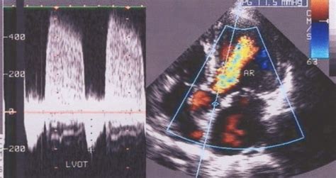 Aortic Regurgitation Cw And Colour Doppler Echocardiograms