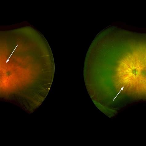 Optos Fundus Photographs Of Both Eyes Showing Gross Choroidal Ischemia