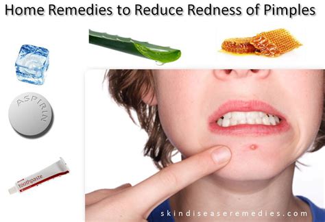How To Reduce Redness Of Pimples Skin Disease Remedies