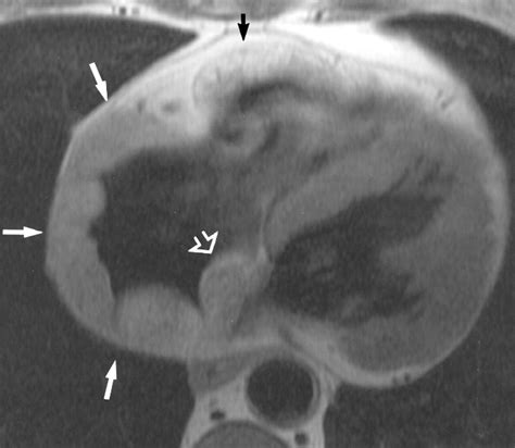 Mri Of Atypical Lipomatous Hypertrophy Of The Interatrial Septum Ajr