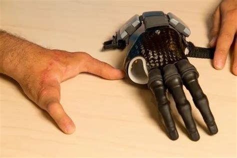 Active Advanced Prosthetic Hand At Rs 15000unit Artificial Limbs