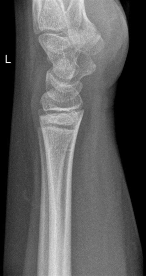 Normal Lateral Wrist Radiograph Paediatric Image