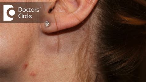 What Causes Swelling Of Lymph Node Near The Ear In A Young Female Dr