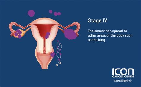 What Is Ovarian Cancer Symptoms And Causes Icon Cancer Center China