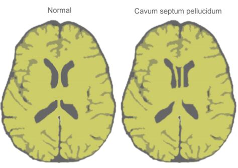 Septum Cavum Pellucidum Prevalence And Risks In Childern