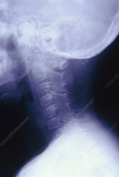 X Ray Of A Neck Affected By Rheumathoid Arthritis Stock Image M110