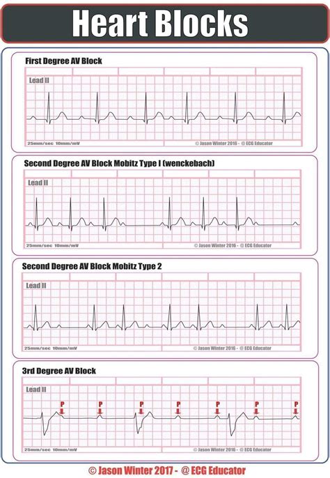 How To Read An Ekg Strip Unugtp News