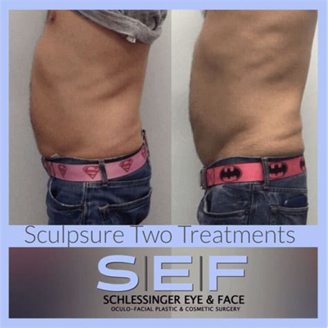Sculpsure Before And After Gallery Schlessinger Eye And Face Woodbury Ny