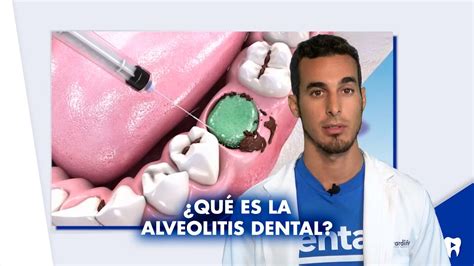 ¿qué Es La Alveolitis Dental Y Qué Tipos Existen Shorts Youtube