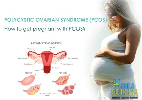 Everything You Need To Know And Do About Pcodpcos Akhila Soukhya