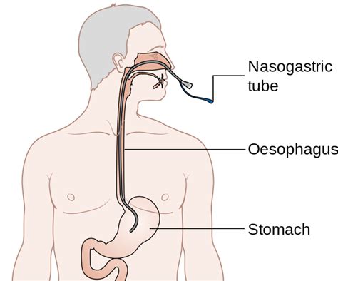 Nasogastric NG Tube Placement Oxford Medical Education