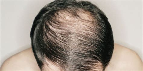 Pin On Baldness Cure