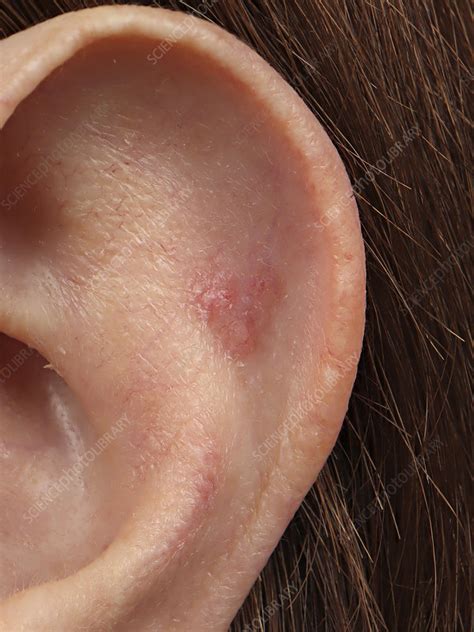 Infiltrating Basal Cell Carcinoma Of The Ear Stock Image C0507401