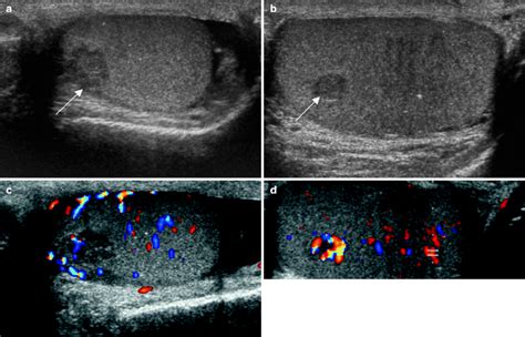 Ultrasound creates pictures of organs and body structures using painless sound waves. Testicular Cancer Imaging | Radiology Key
