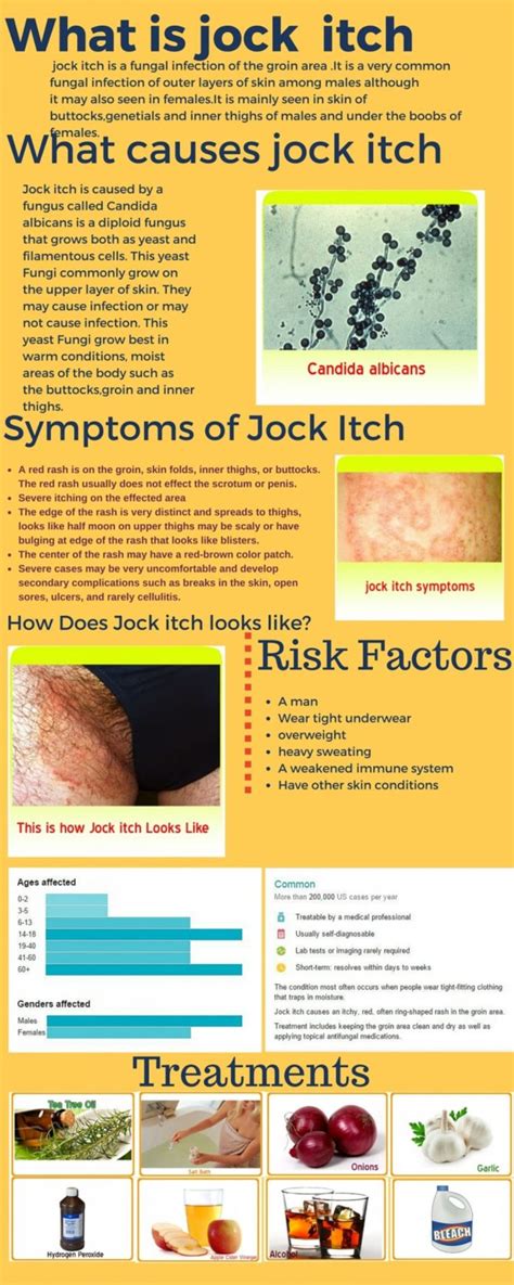 Jock Itch Or Herpes Heres How To Tell The Difference Infographic