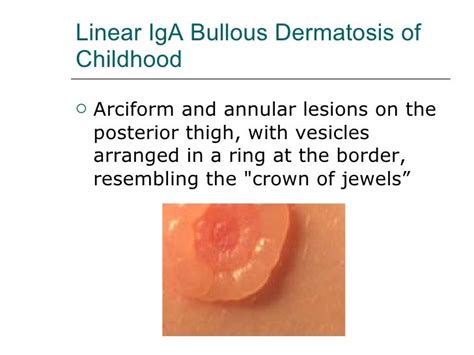 Linear Iga Bullous Dermatosis Ii