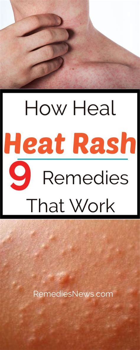 Heat Rash Remedies For Adults