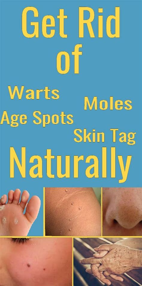 How To Get Rid Of Warts Moles Age Spots And Skin Tag Using Natural