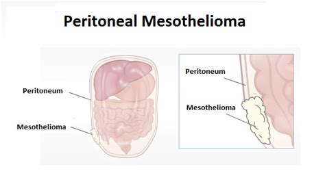 Around 80% of mesothelioma cases are pleural mesothelioma. Treatment Of Peritoneal Mesothelioma