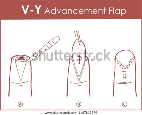 Vector Illustration Vy Advancement Flap