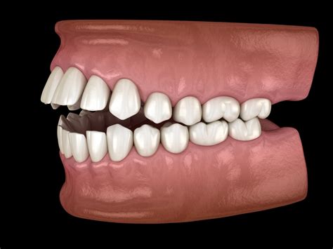 What Is A Malocclusion Hockenberger Orthodontics