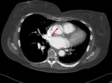 Incidental Finding Of Type A Aortic Dissection And Treated With A Ct