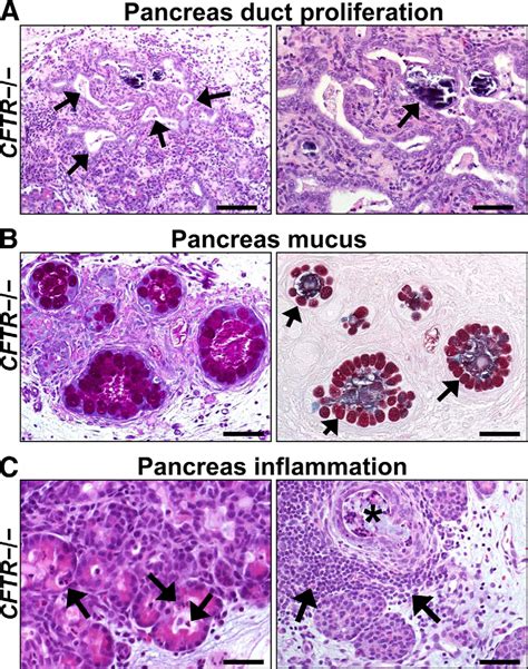 Cystic fibrosisti pancreasti free full textsb. Pathology of Gastrointestinal Organs in a Porcine Model of ...