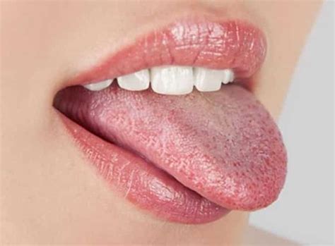 5 Things Your Tongue Can Tell You about Your Health