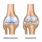 Alternative Treatments For Arthritis Knee Pain Pictures