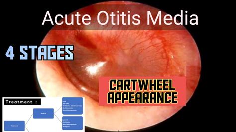 Acute Otitis Media Etiology Signs Stages Treatment Ent Medu