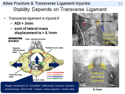 Atlas Fractures And Transverse Ligament Injuries Spine Orthobullets