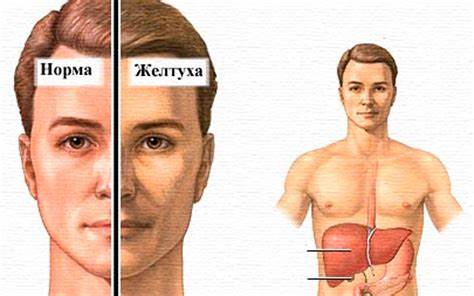 Диета при желтухе