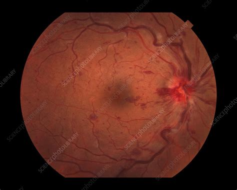 Central Retinal Vein Occlusion Stock Image C0271172 Science