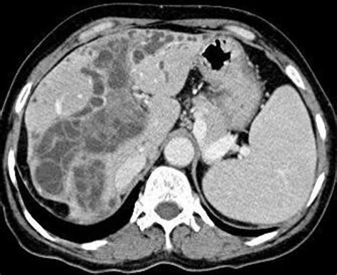 Ct Image Showing Dilated Bile Ducts Which Contain Lineer Hyperdens