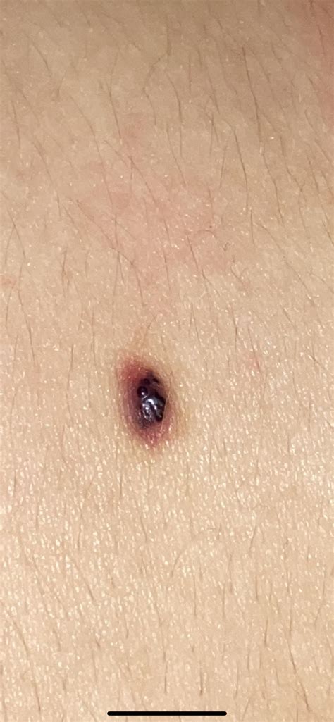 Blood Blister Or Should I Go Get It Looked At Rmelanoma