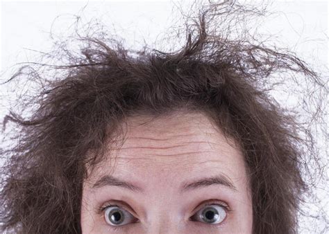 What Are Some Causes Of Dry Scalp With Pictures
