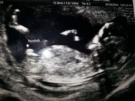 The sonographer will apply a gel on. 12 week ultrasound. Gender guesses please! - Page 1 ...