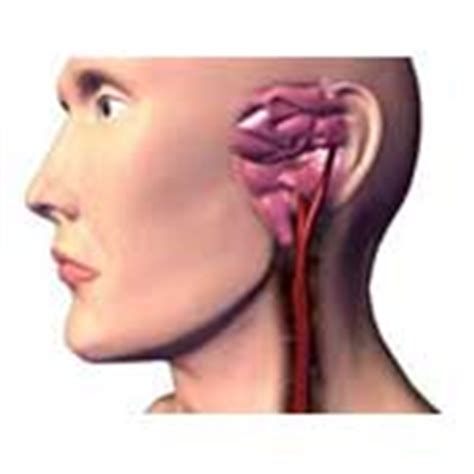 The carotid arteries run up either side of your neck. Carotid Artery Blockage Surgery - When Is It Required?