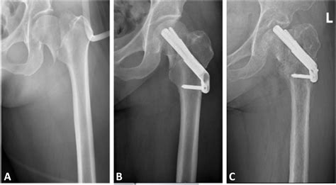 Preoperative Anteroposterior Radiograph Of A Left Femoral Neck Fracture