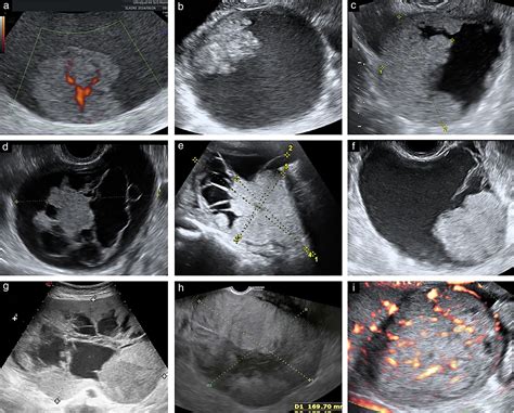 Ovarian Cancer Tumor Ultrasound