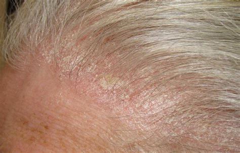 How To Treat A Scabby Scalp Ds Laboratories Germany
